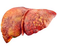 picture of a fatty liver and a guide for treating fatty liver